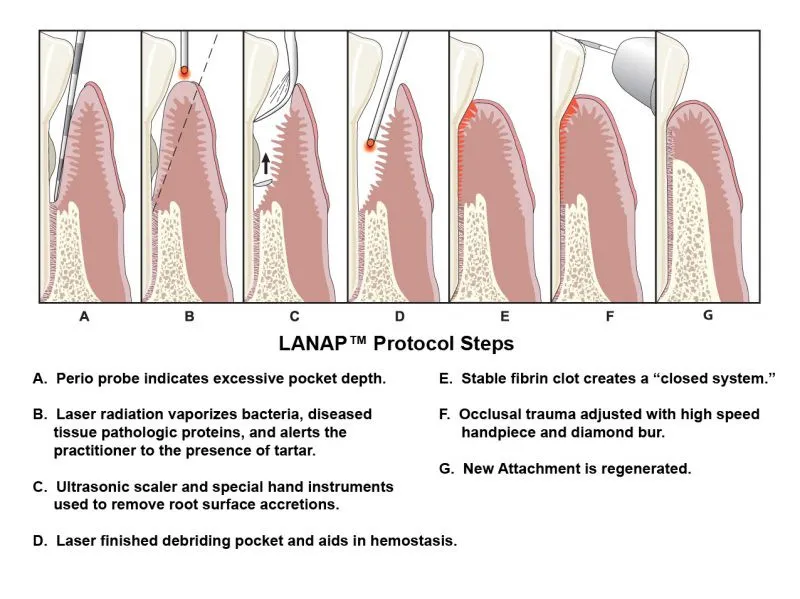 Diagram showing Periodontal laser therapy protocol steps