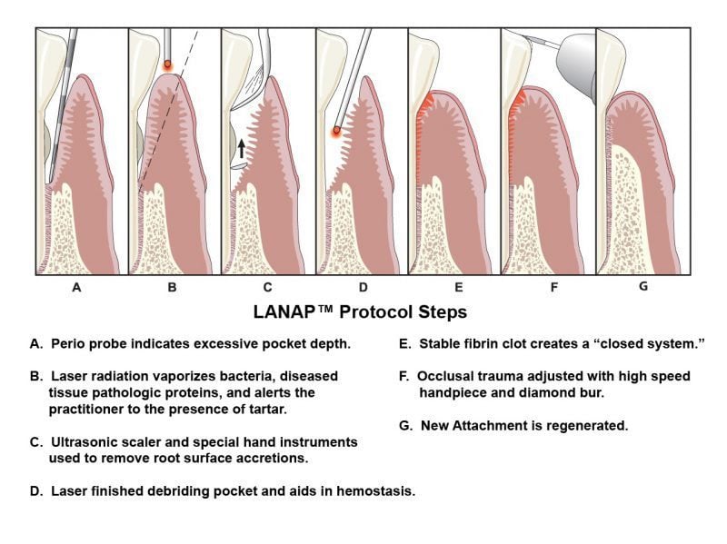 Diagram showing Periodontal laser therapy protocol steps