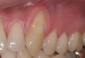 Patient's mouth before gum grafting