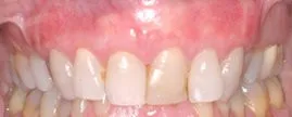 Patient's mouth after gum grafting