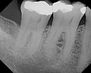 X-ray showing the second step of bone regeneration