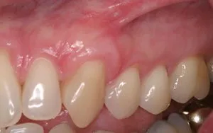 Patient's mouth after gum grafting