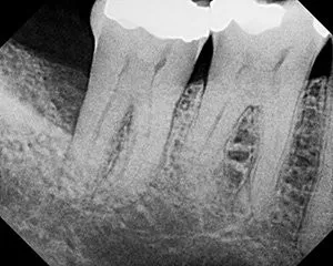X-ray showing the first step of bone regeneration