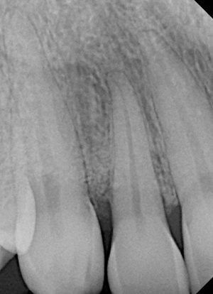 X-ray showing the thrid step of bone regeneration