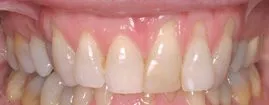 Patient's mouth before gum grafting