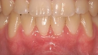 Patient's mouth after gum grafting