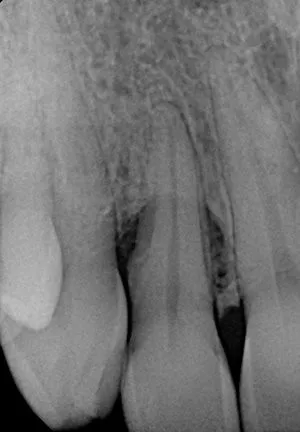 X-ray showing the fourth step of bone regeneration
