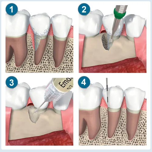 Illustrated steps of bone regeneration