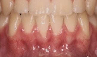 Patient's mouth before gum grafting