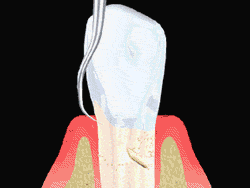 An animated illustration showing the process of root planing